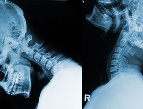 X-ray of neck when it is flexed and extended