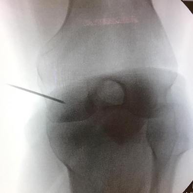 X-ray of knee bones